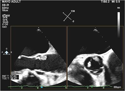 Case Report: A Tale of a Cardiac Mass: Looks Like a Papillary Fibroelastoma, Acts Like a Non-bacterial Thromboendocarditis